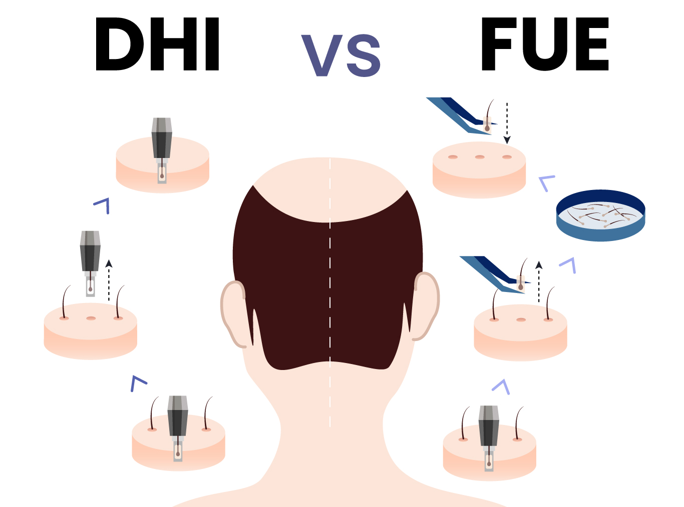 DHI Vs FUE Hair Transplant